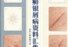 牛皮癣银屑病资料汇集pdf